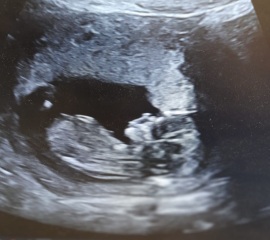 12 week scan - Ramzi or Nub Theory help.