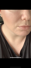 Tretinoin questions