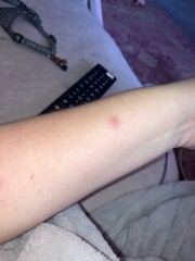 To be worried about this rash?