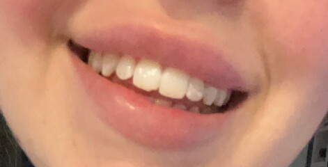 Bit of Filler... husband furious!