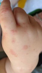 Can someone please talk to me about bastard chickenpox or whatever the hell this is?!