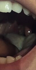 Does this look like tonsillitis / strep throat