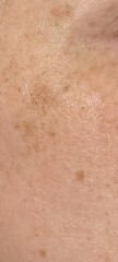 Get rid of freckles / Lentigo on face?