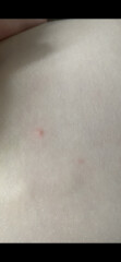 Is this chicken pox?! 