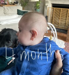 Flat head brachycephaly plagiocephaly