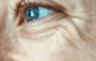 Botox at 30? Lines under eyes