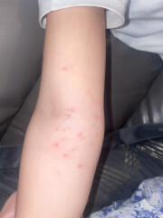 Treatment ideas - molluscum contagiosum?