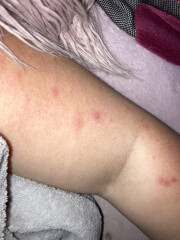 To be worried about this rash?