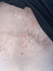 Rash/Eczema/Psoriasis ?