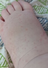 Can someone please talk to me about bastard chickenpox or whatever the hell this is?!