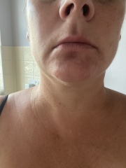 Bitten by something. 