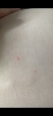 Chicken pox?