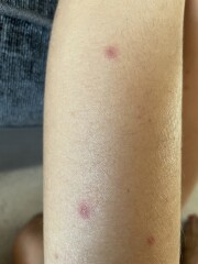 Does this look crusted? (Chicken pox)