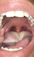 Does this look like tonsillitis / strep throat