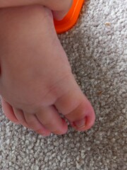 Advice please, baby toes