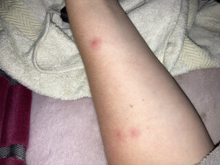 To be worried about this rash?