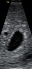6 week scan no baby seen? 