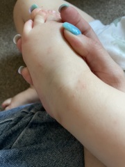 What is this rash?