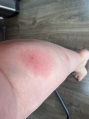 Bite getting bigger....