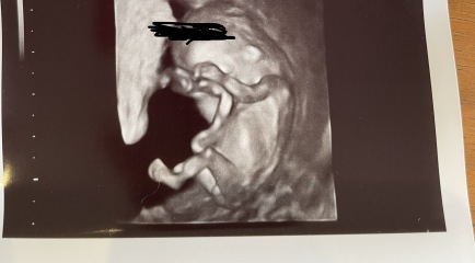Boy or girl - Nub/skull guesses welcome :)