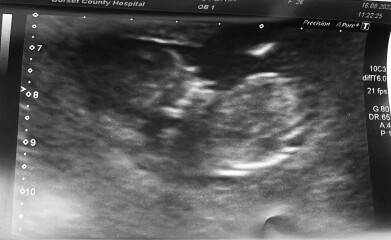 12 Week Scan - Boy or Girl?