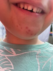 3 year old, same spots on chin for weeks