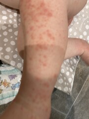 Is this chicken pox or hand foot and mouth?! 
