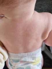 Rash on baby