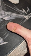 Wart cluster on my thumb is driving me crazy! What wart removal stuff would anyone recommend please.