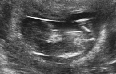 12 Week Scan - Boy or Girl?