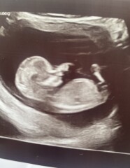 12 Week Scan - Boy or Girl?