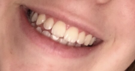 Bit of Filler... husband furious!