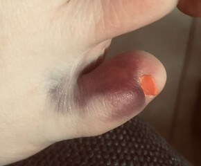 Does my toe look broken?