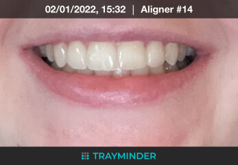 To ask if you found Invisalign worth it? 