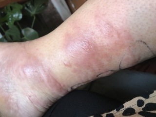 Does this look like cellulitis?
