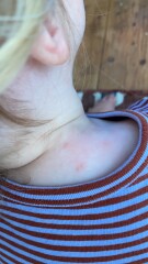 Help! Is this chicken pox?