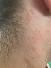 Rash/Eczema/Psoriasis ?