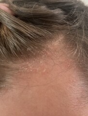 Scalp issues - dermatitis??