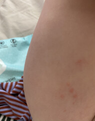 Help! Is this chicken pox?