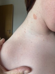 Mystery rash/spots on 10yr old. Any ideas?
