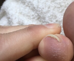 Any podiatrists? Toe/nail issue  WITH PICTURE