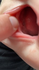 Hard lump? Or teeth?