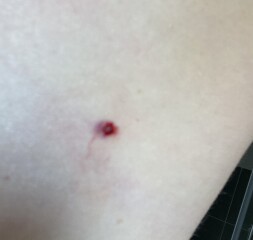What the heck was on my skin?! 