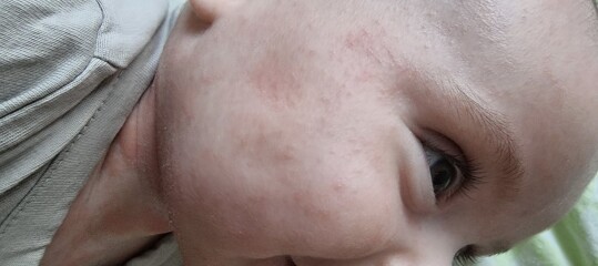 Is this a dribble rash or something else? Help a panicky FTM out!