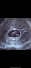 TTC for 10 Months... Am I finally pregnant?