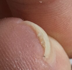 Any podiatrists? Toe/nail issue  WITH PICTURE