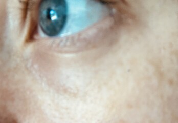 Botox at 30? Lines under eyes