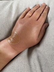 Infected bite, when to get further help? 