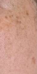 Get rid of freckles / Lentigo on face?