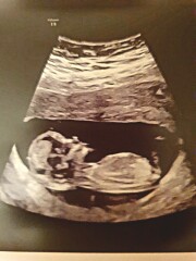 What do you think.. Boy or girl? 12week scan